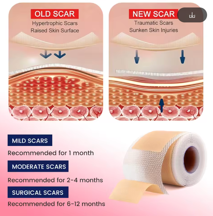 Silicone Scar Patch 4x300cm – Stretch Mark & Scar Treatment Strip